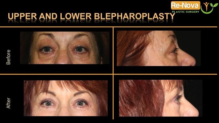 Before and after photos of an eyelid surgery patient.
