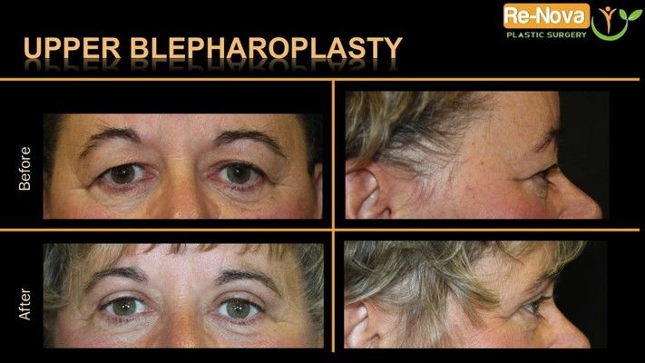 Before and after photos of an eyelid surgery patient.