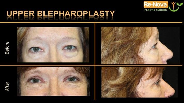 Before and after photos of an eyelid surgery patient.