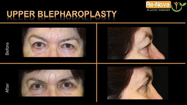 Before and after photos of an eyelid surgery patient.