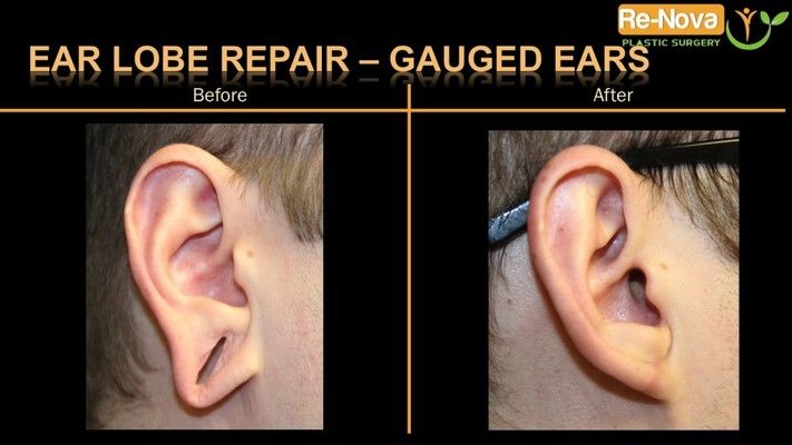 Before and after photos of an earlobe repair patient.