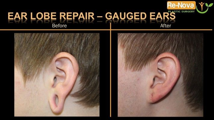 Before and after photos of an earlobe repair patient.