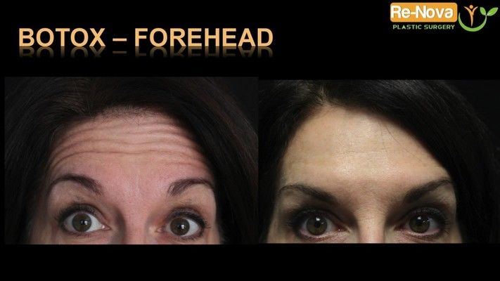 Before and after images of a Botox patient.