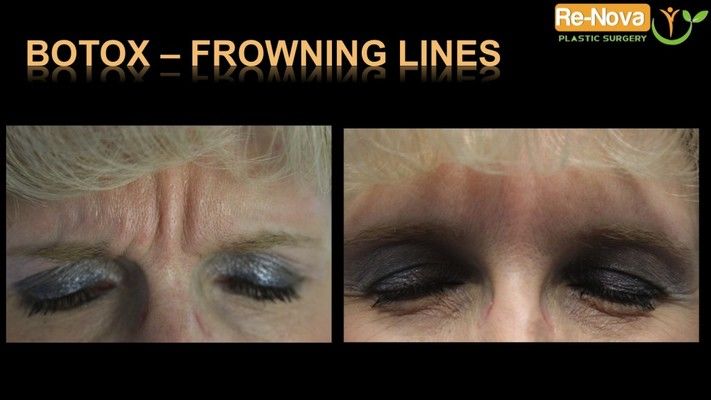 Before and after images of a Botox patient.