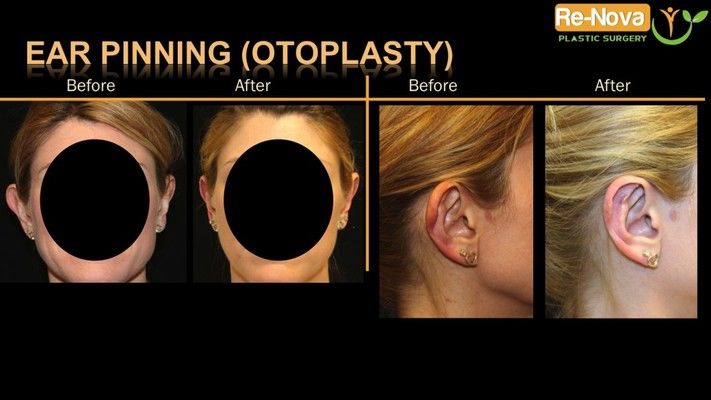 Otoplasty patient before and after photos.