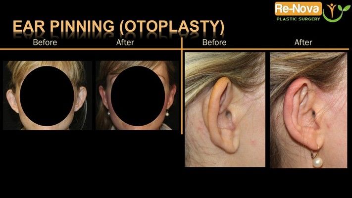 Otoplasty patient before and after photos.