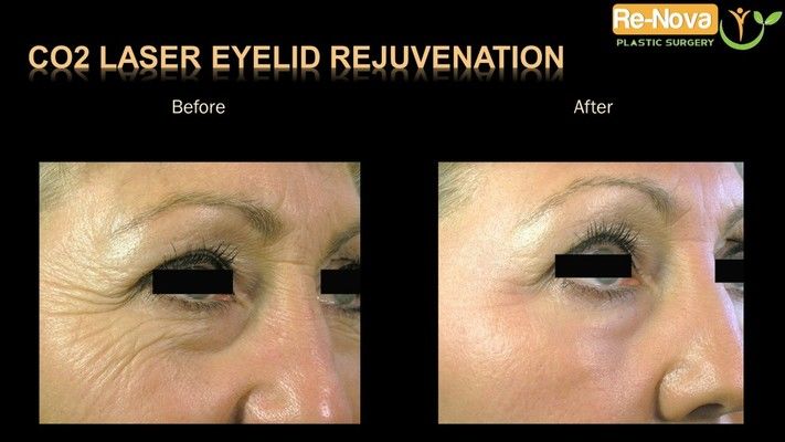 CO2 laser eyelid rejuvenation patient, before and after.