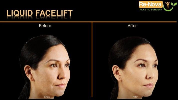 Before and after photos of liquid facelift patient.