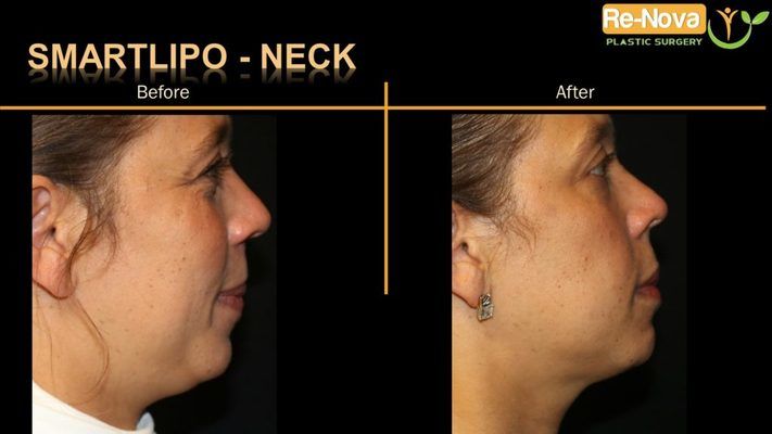 Before and after image SmartLipo.