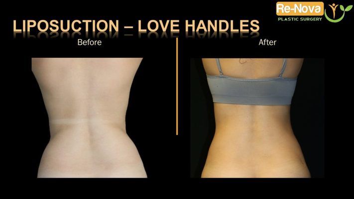 Before and after image SmartLipo.