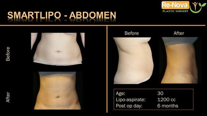 Before and after image SmartLipo.