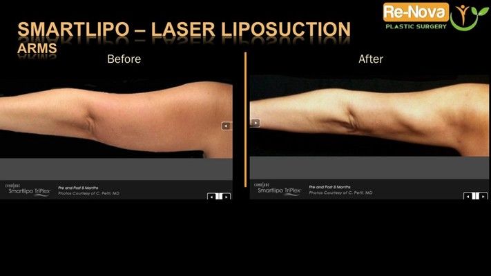 Before and after image SmartLipo.