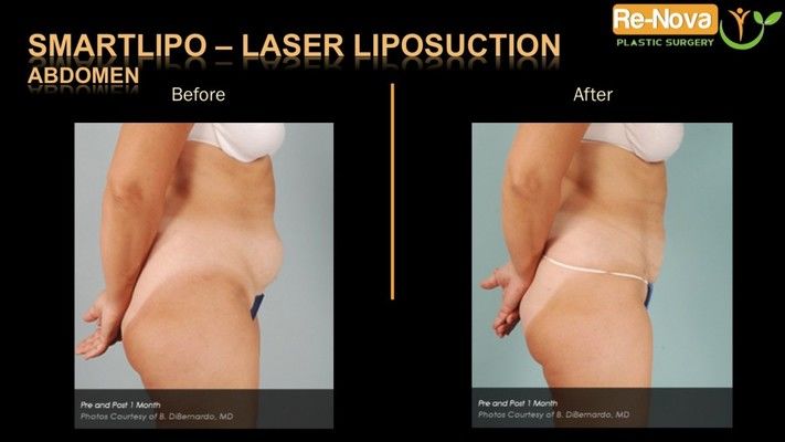 Before and after image SmartLipo.