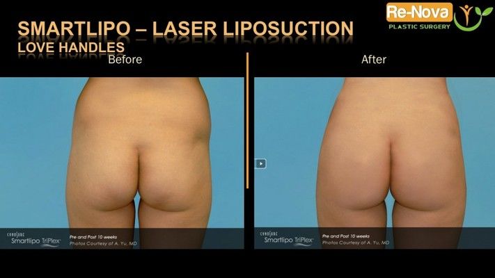 Before and after image SmartLipo.