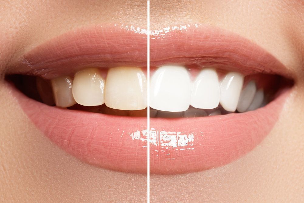 image of teeth whitening before and after