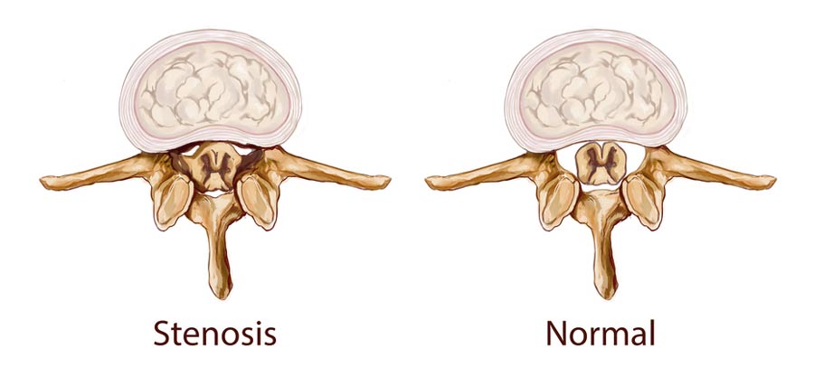 side by side of spinal canal with or without stenosis