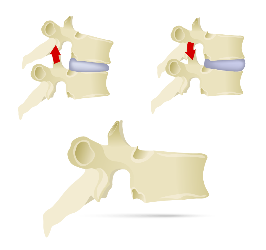 Diagram of vertebra affected by facet syndrome