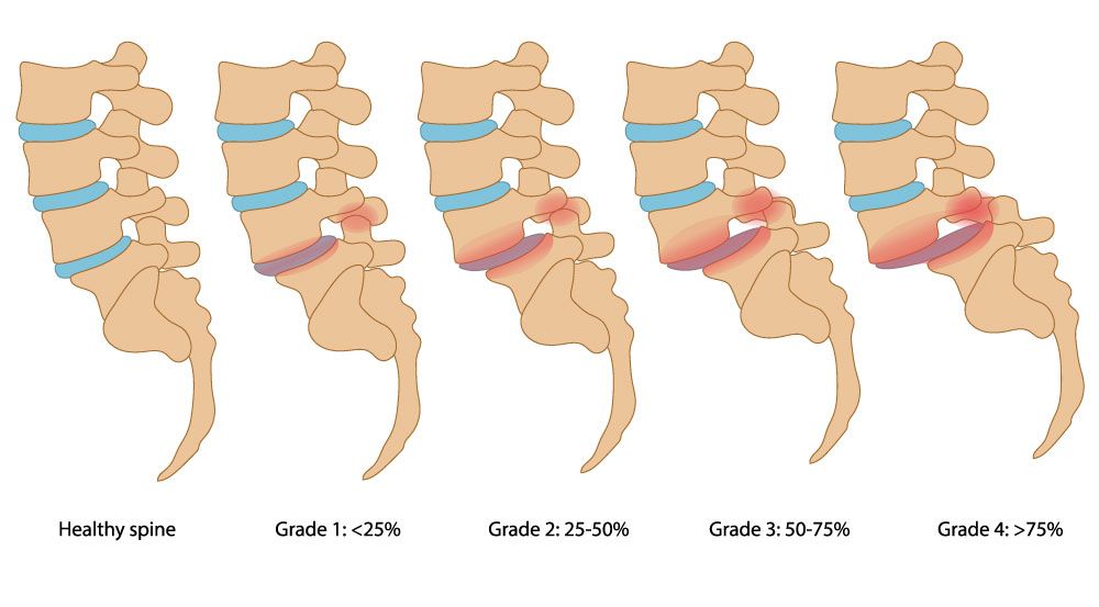 Low vs. high-grade spondylolisthesis