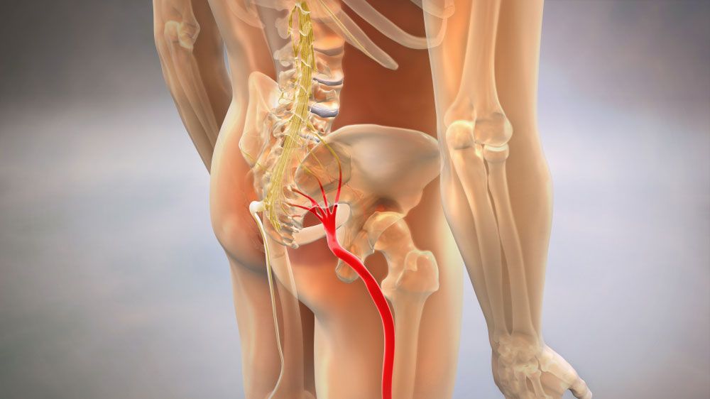 Inflamed sciatic nerve