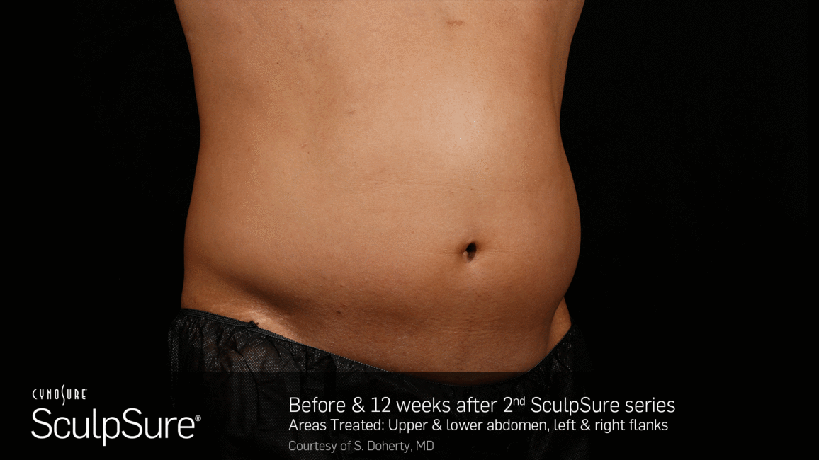 Marketing image for SculpSure®.