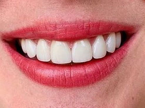 after cosmetic dentistry