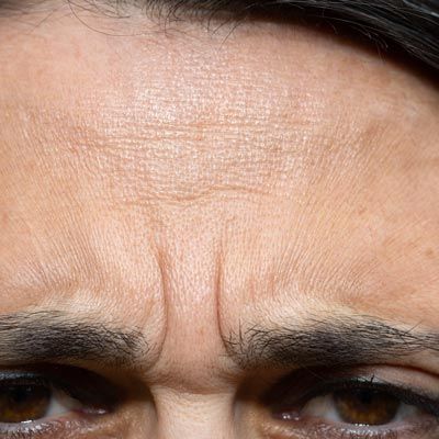 Wrinkles between a person's eyebrows