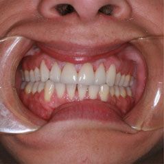 After porcelain veneers