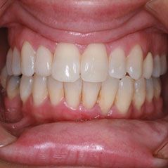 After Invisalign