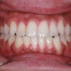 After Invisalign