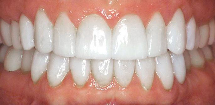 After full mouth reconstruction photo