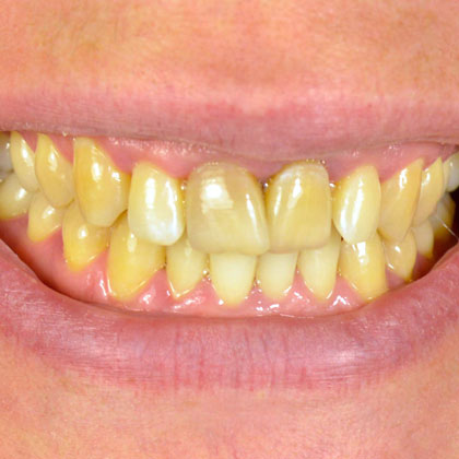 Yellowed teeth