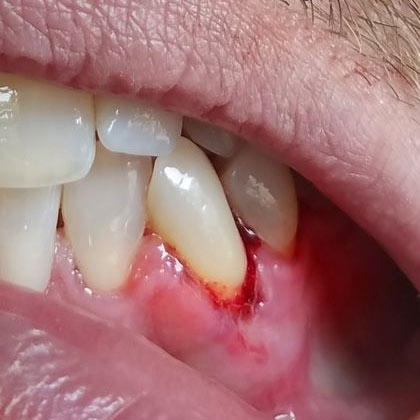 Infected gums