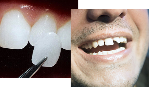 bonding vs veneers