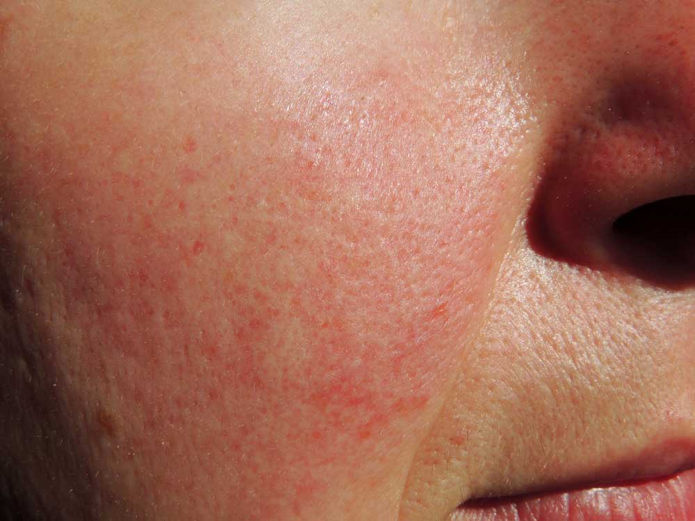 rosacea