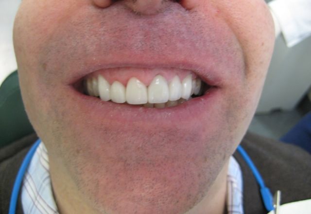 image of before/after porcelain veneers treatment