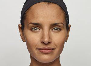 Woman's smooth brow after Dysport injections