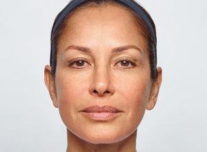 Woman's smooth brow after Dysport injections