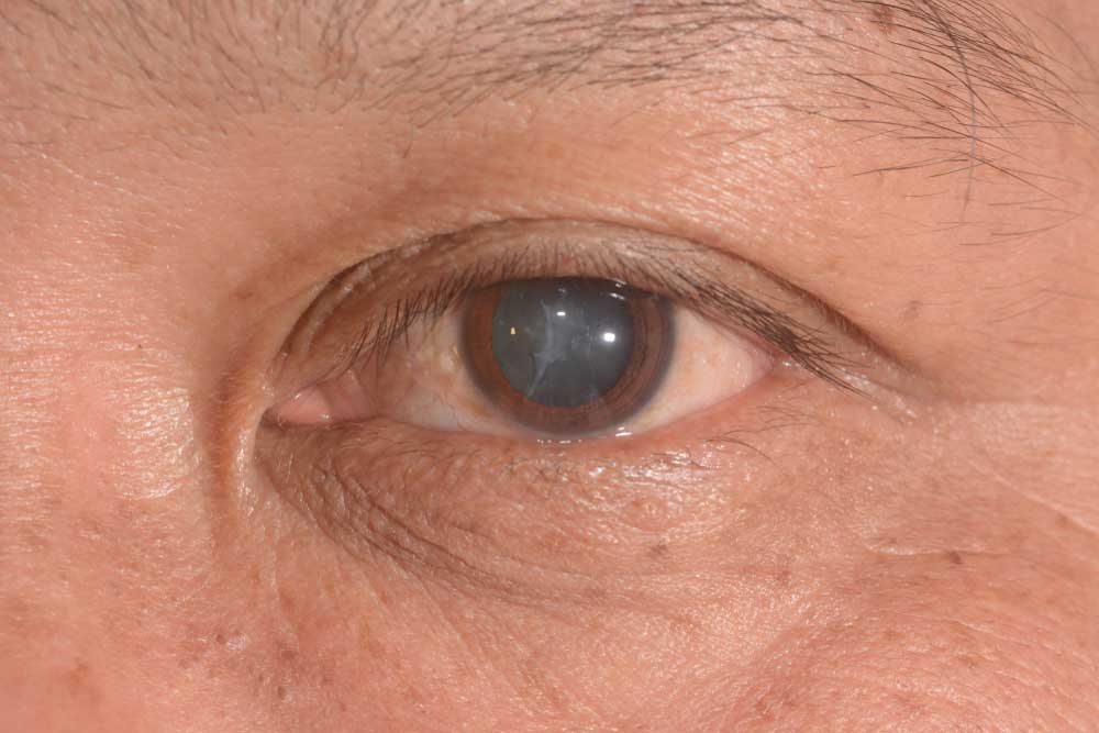Close up of eye with cataract
