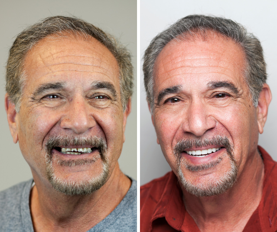 Before and after full mouth reconstruction