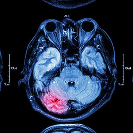 Second Impact Syndrome