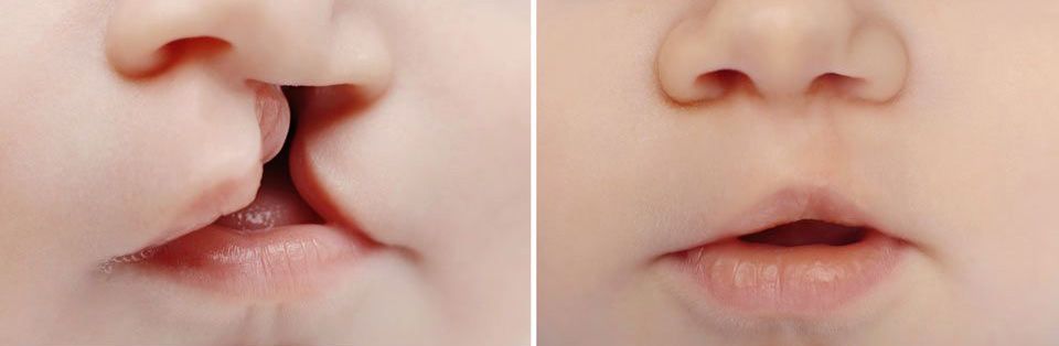 Photo of a child with a cleft lip