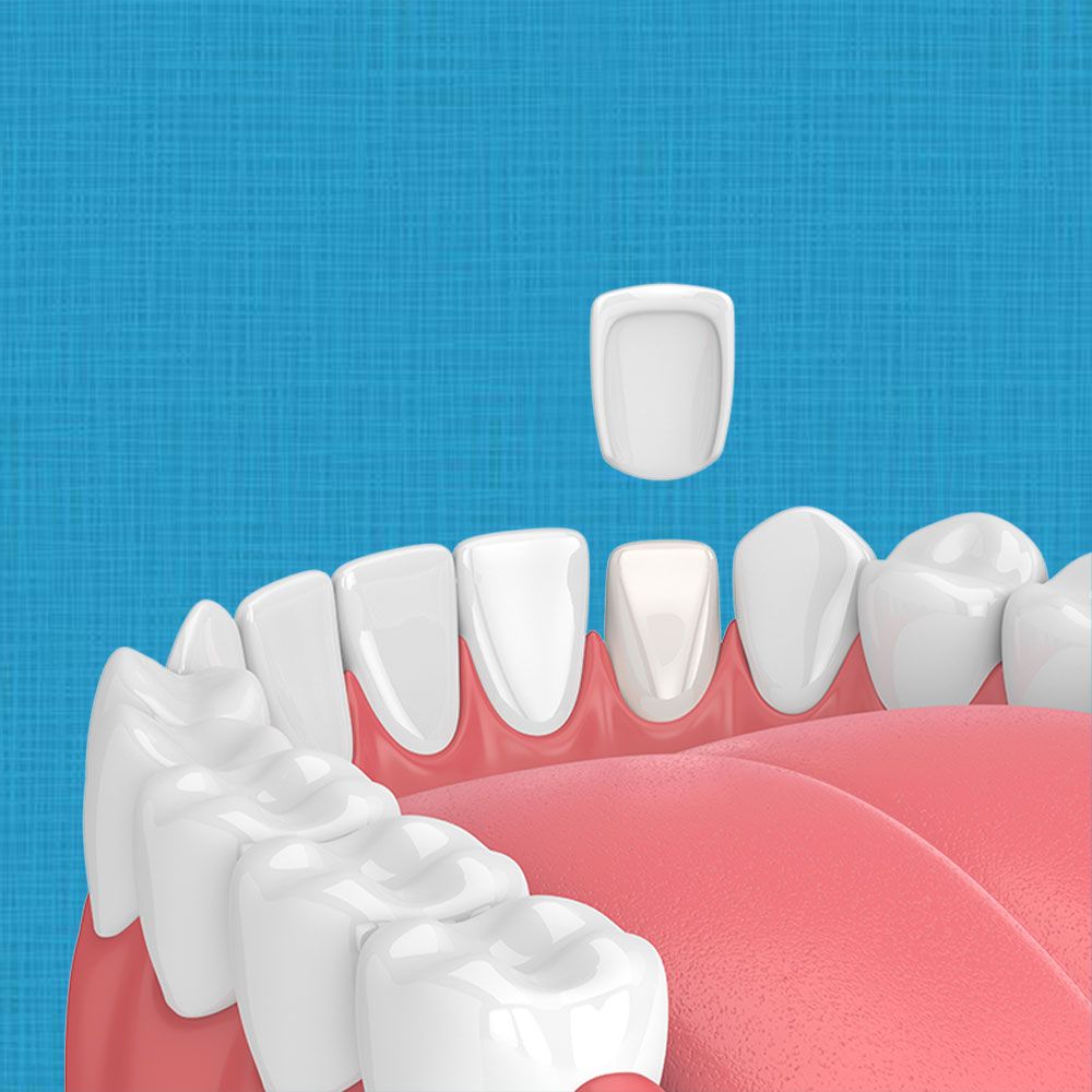Porcelain veneer fitting onto tooth