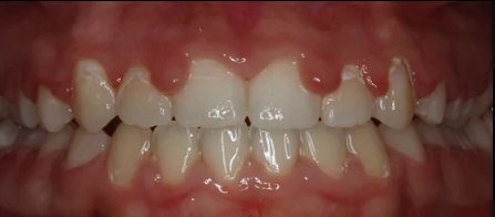 Patient with gingivectomy.