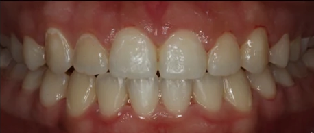 Restored gum health.