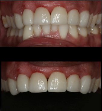 After a smile makeover.