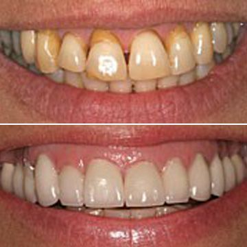 Before and after a smile makeover