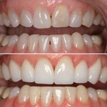 Before and after dental bonding