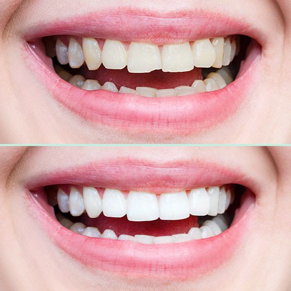 dental bonding before and after