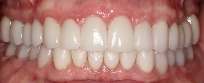 white straight teeth after cosmetic dentistry