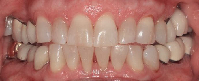 yellow teeth before cosmetic dentistry